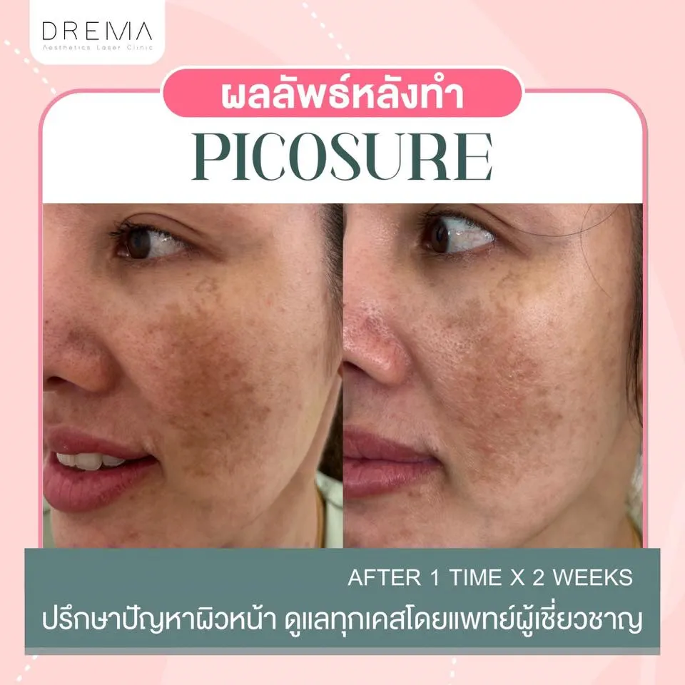 picosure