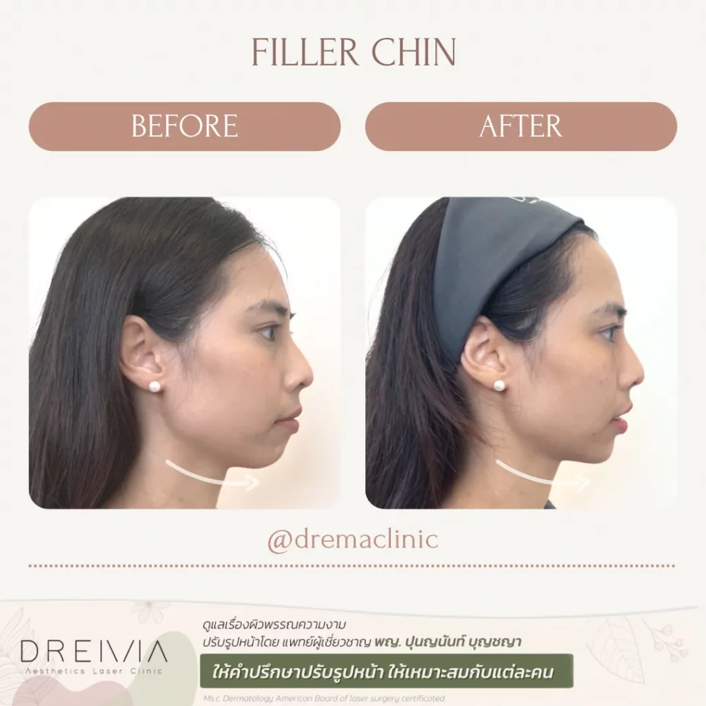 รีวิวฟิลเลอร์คาง