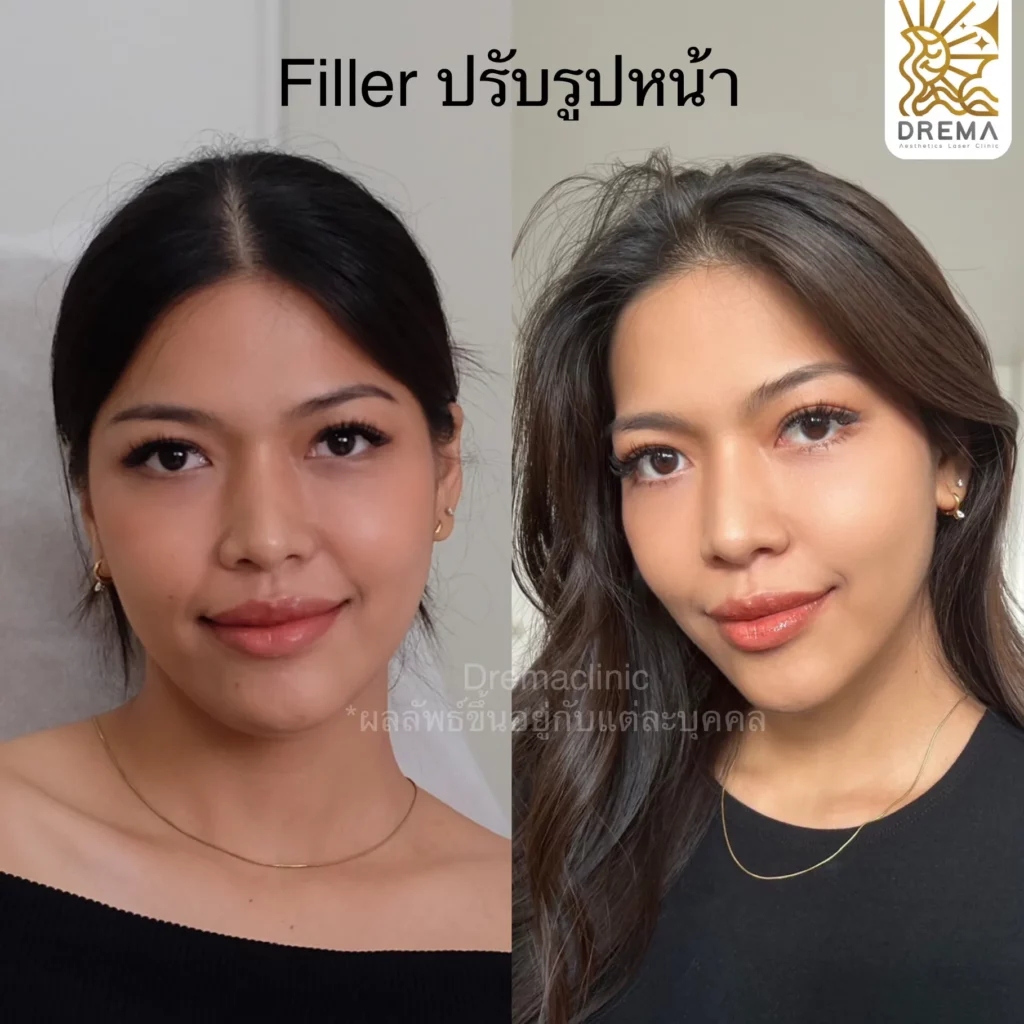รีวิวการปรับรูปหน้า