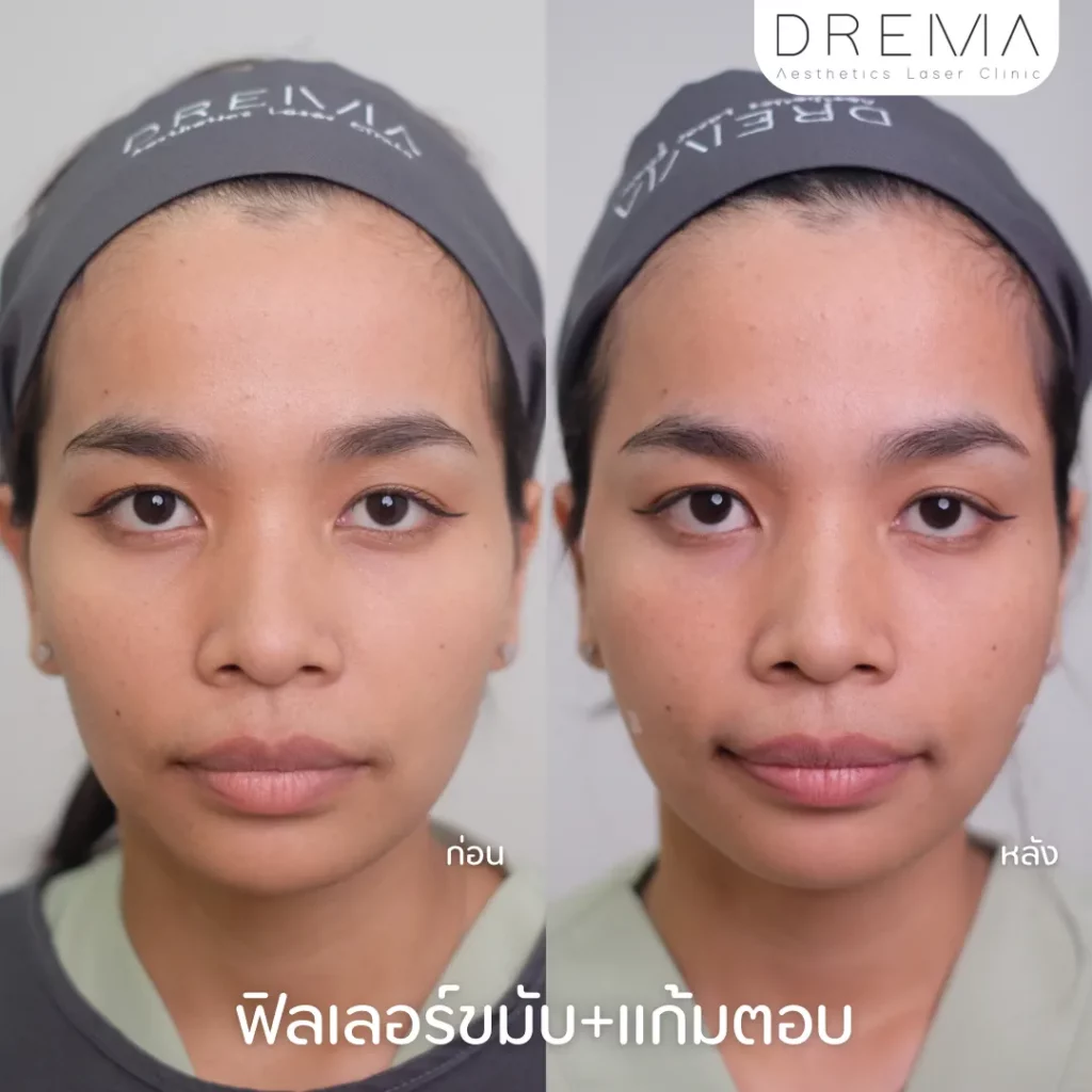 รีวิวการปรับรูปหน้า