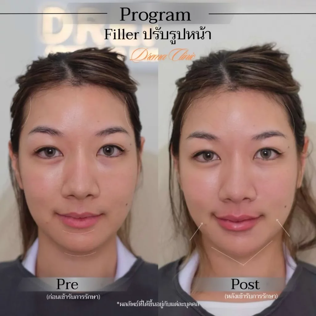 รีวิวการปรับรูปหน้า