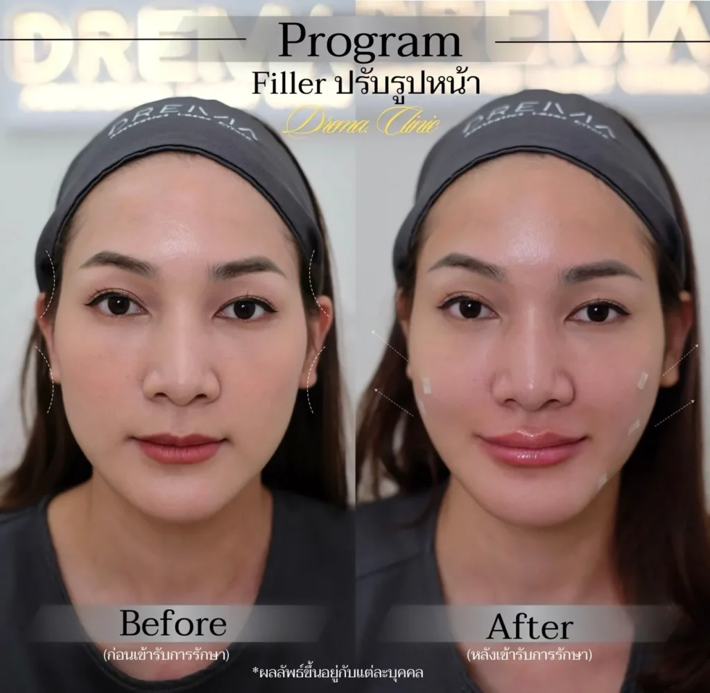 รีวิวการปรับรูปหน้า