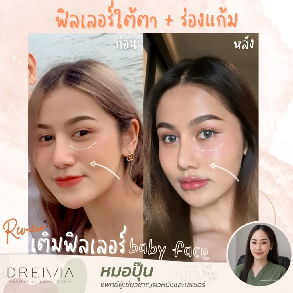 รีวิว Filler แก้มตอบ ร่องแก้ม
