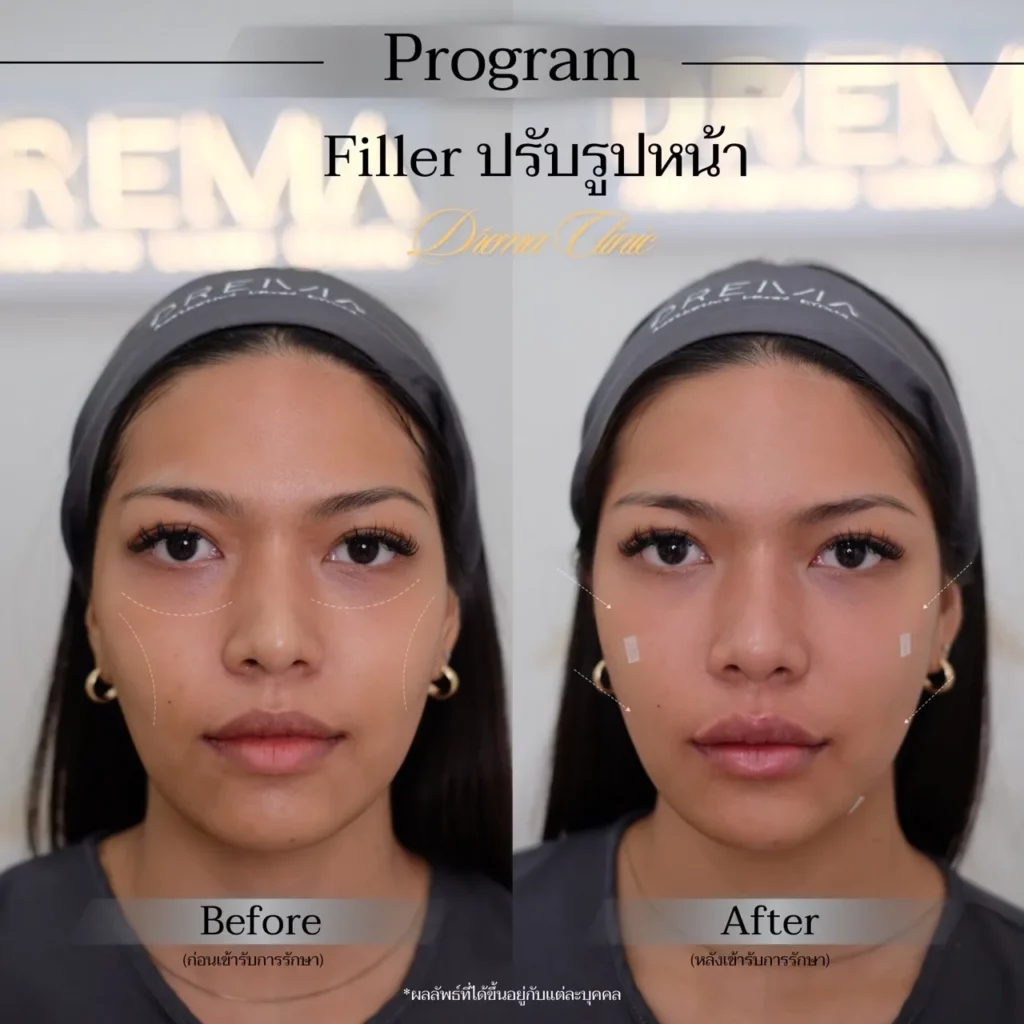 รีวิวการปรับรูปหน้า
