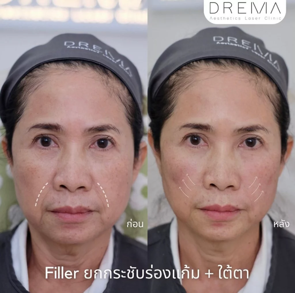 รีวิว Filler แก้มตอบ ร่องแก้ม