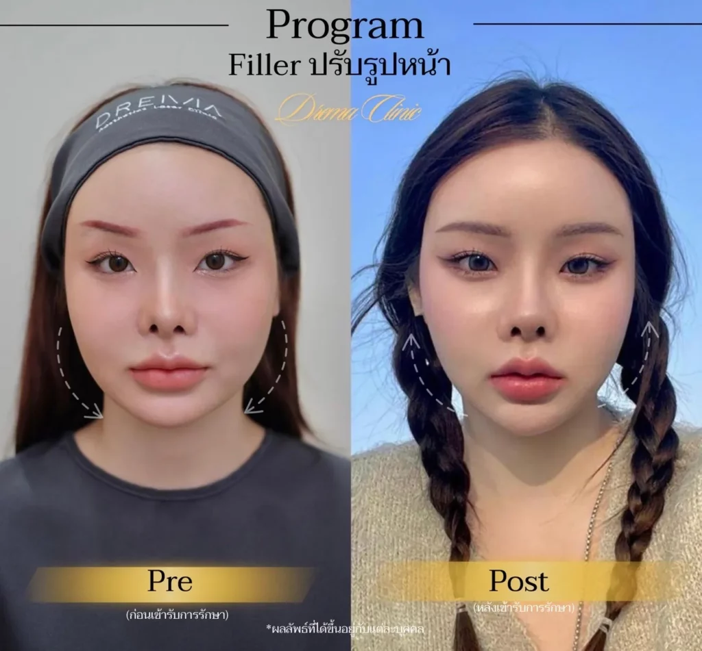 รีวิวการปรับรูปหน้า