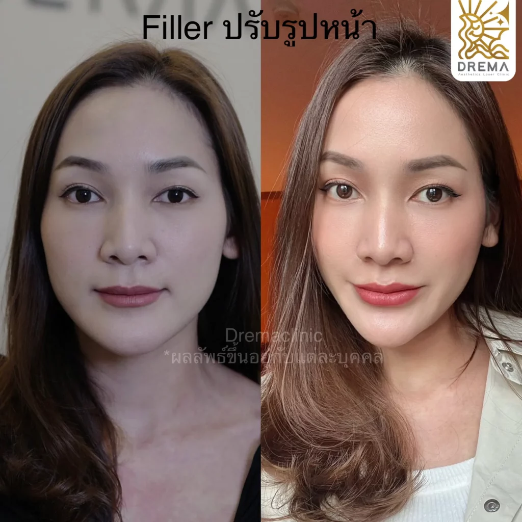 รีวิวการปรับรูปหน้า