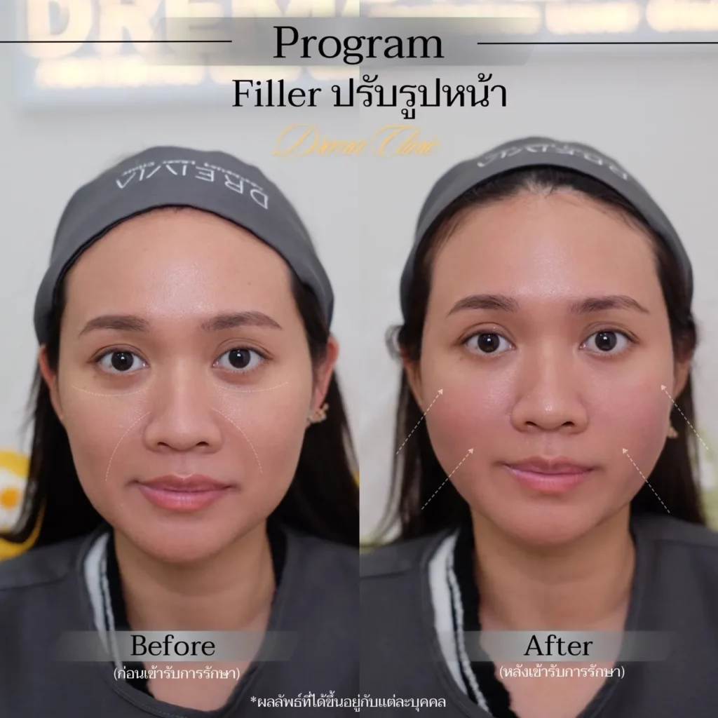 รีวิวการปรับรูปหน้า