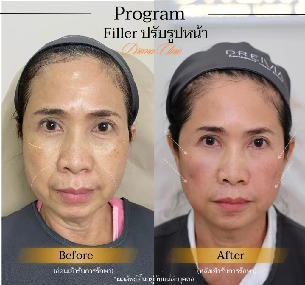 รีวิวการปรับรูปหน้า