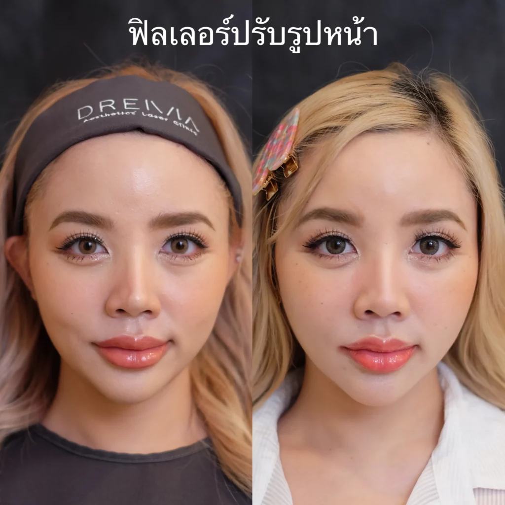 รีวิว Filler แก้มตอบ ร่องแก้ม