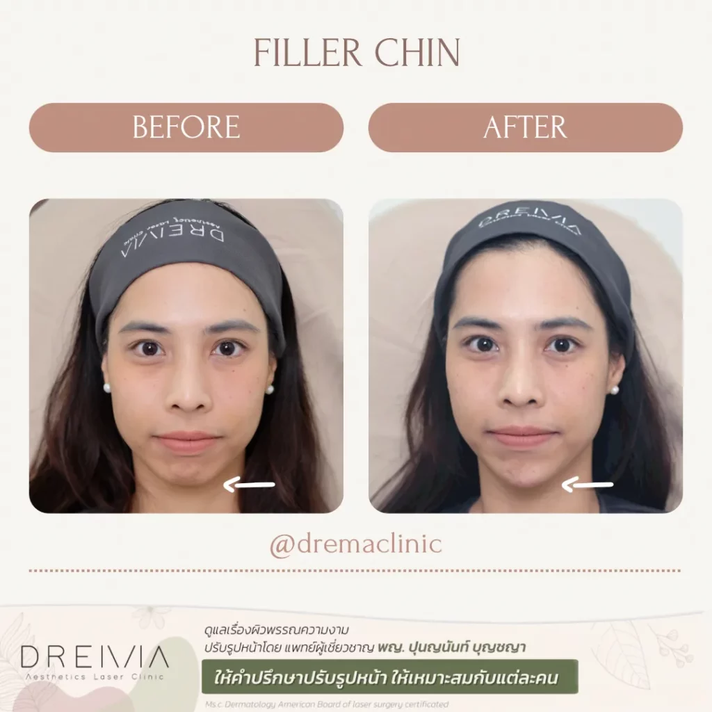 รีวิวฟิลเลอร์คาง