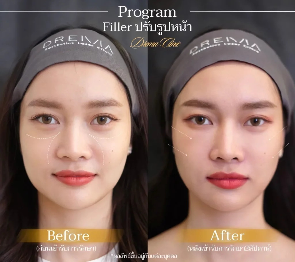 รีวิวการปรับรูปหน้า
