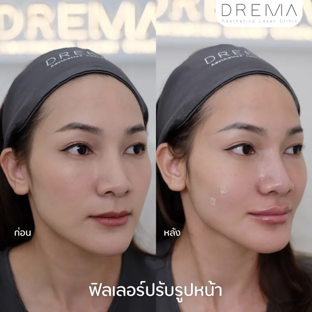 รีวิวการปรับรูปหน้า