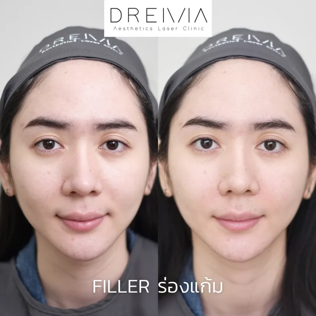 รีวิว Filler แก้มตอบ ร่องแก้ม