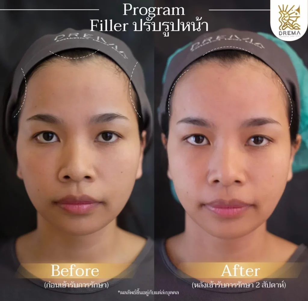 รีวิวการปรับรูปหน้า