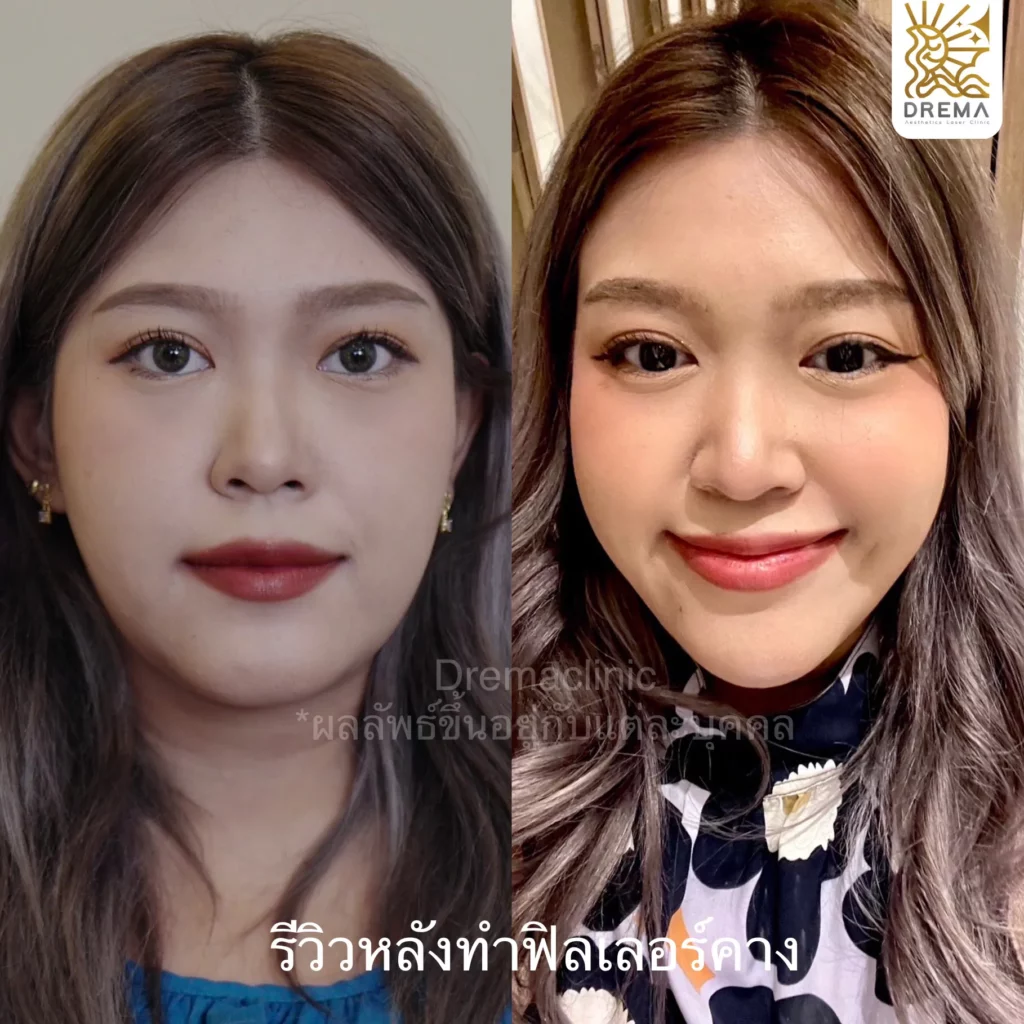 รีวิวฟิลเลอร์คาง