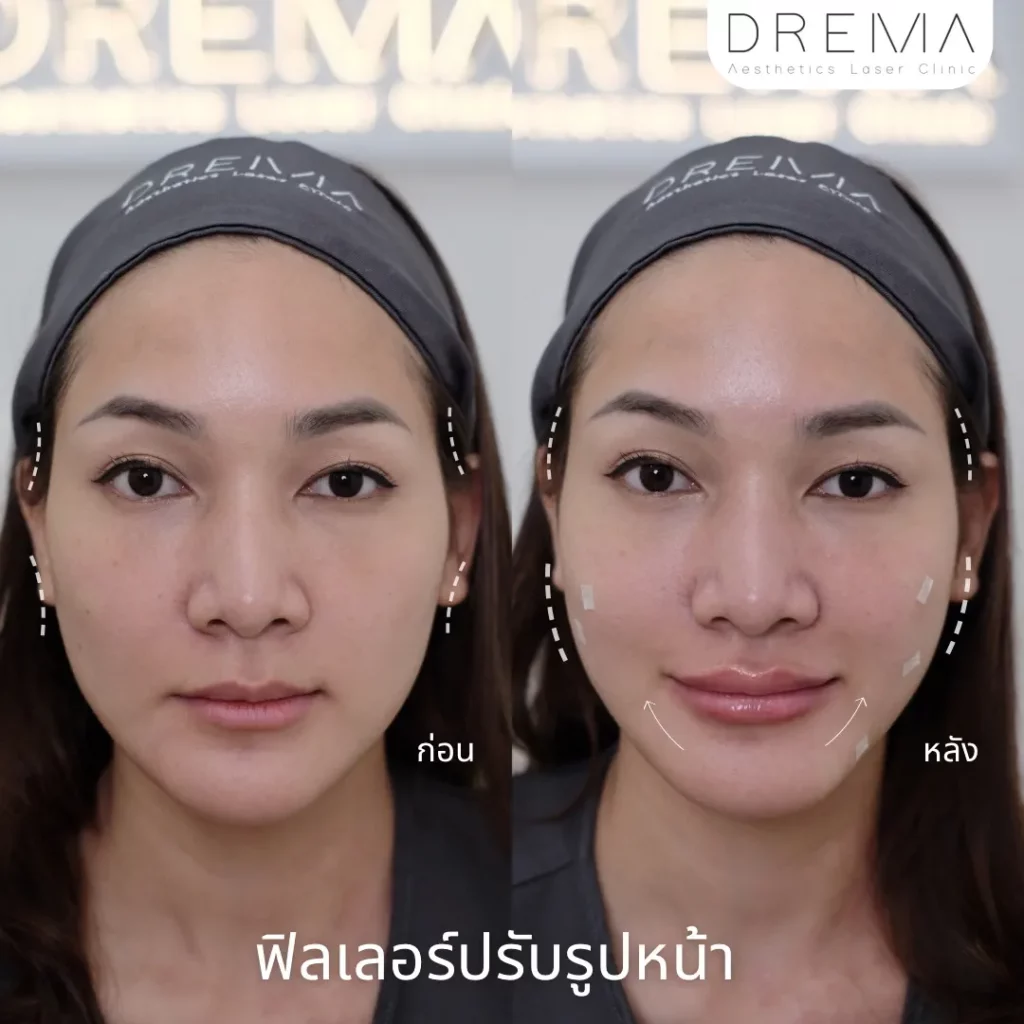 รีวิวการปรับรูปหน้า