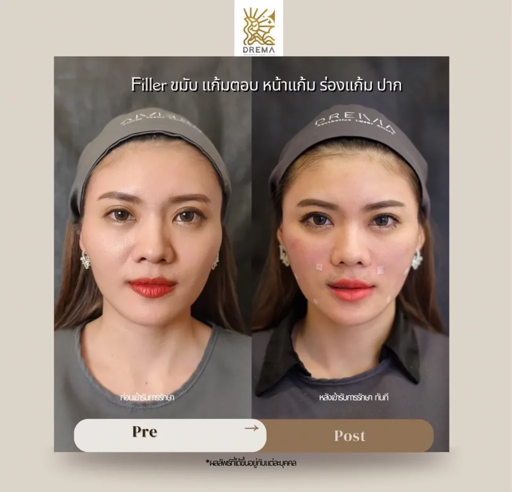 รีวิวการปรับรูปหน้า