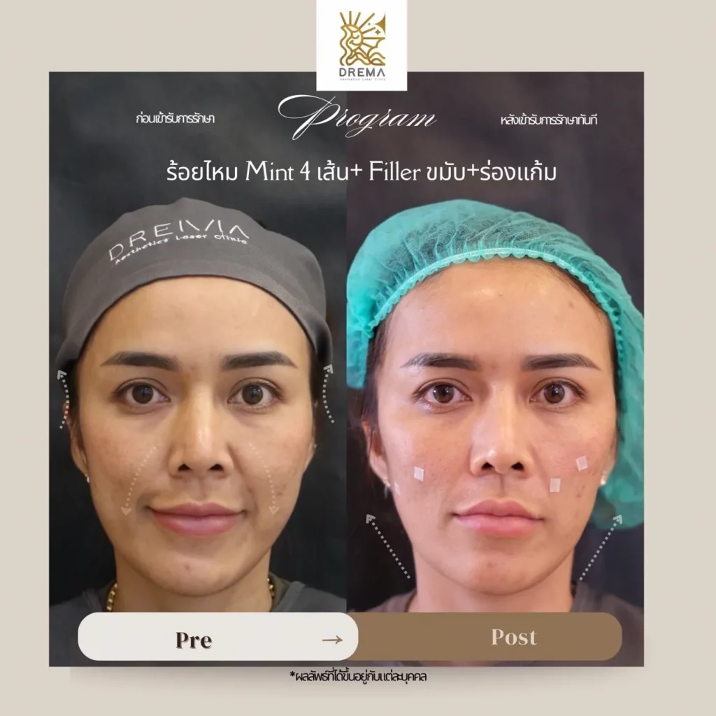 รีวิว Filler แก้มตอบ ร่องแก้ม