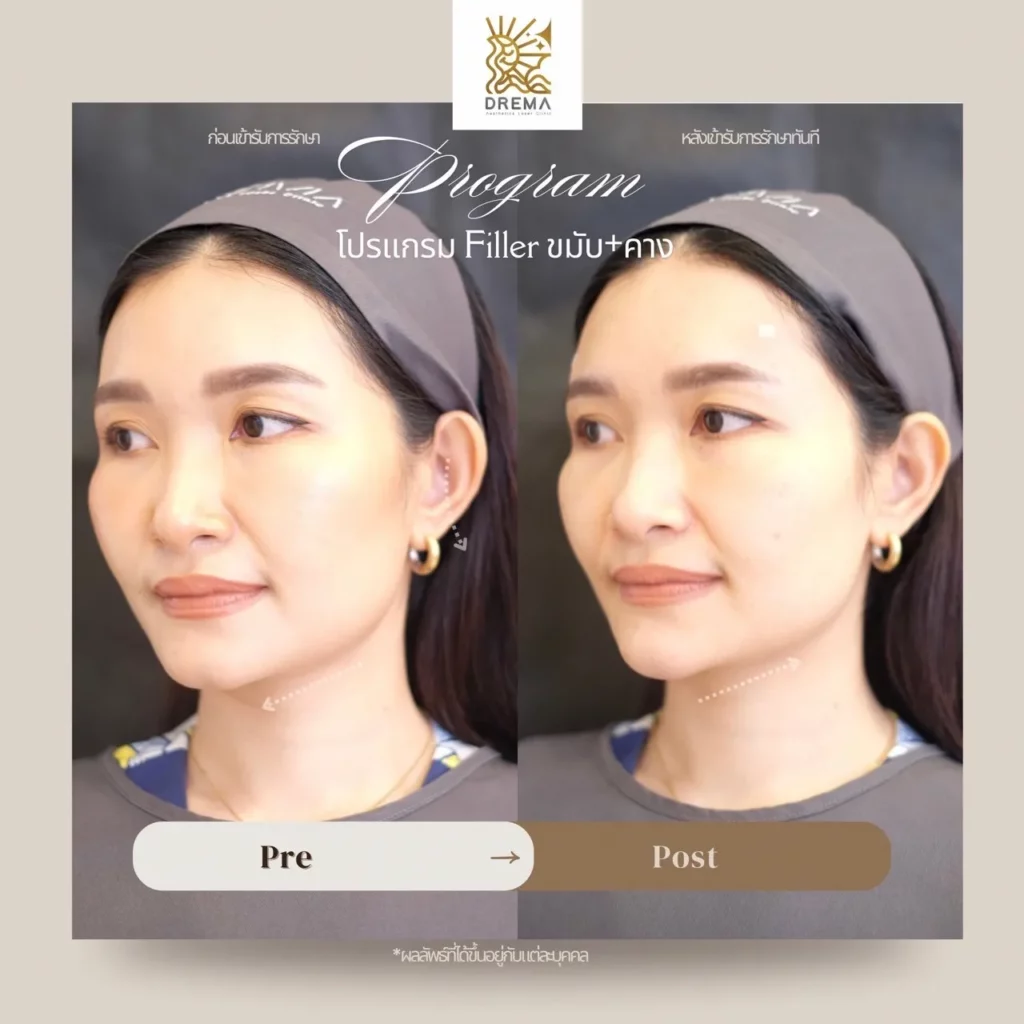 รีวิวฟิลเลอร์คาง