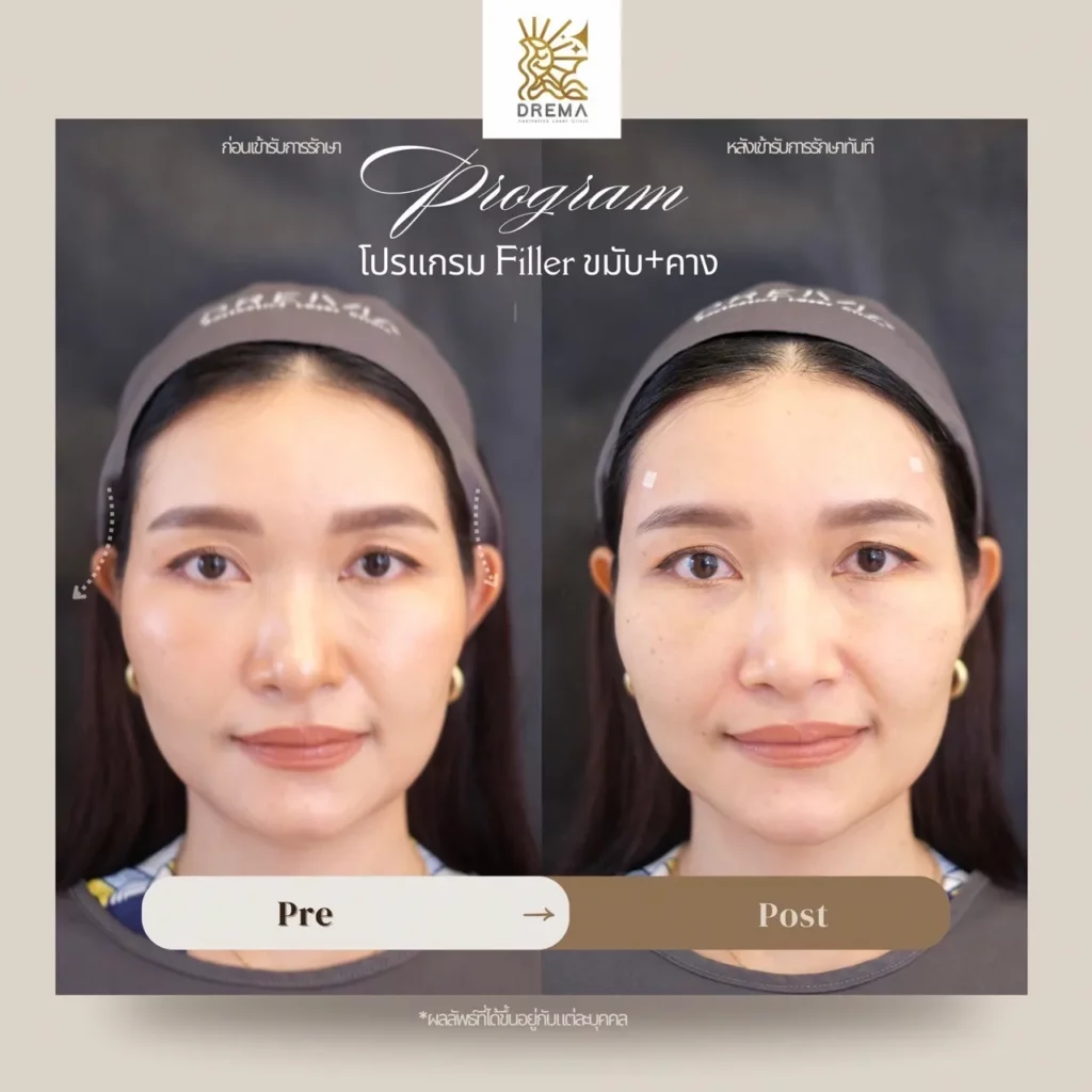รีวิวการปรับรูปหน้า
