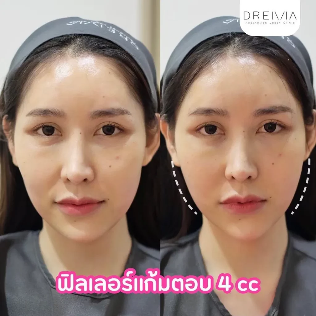 รีวิวการปรับรูปหน้า