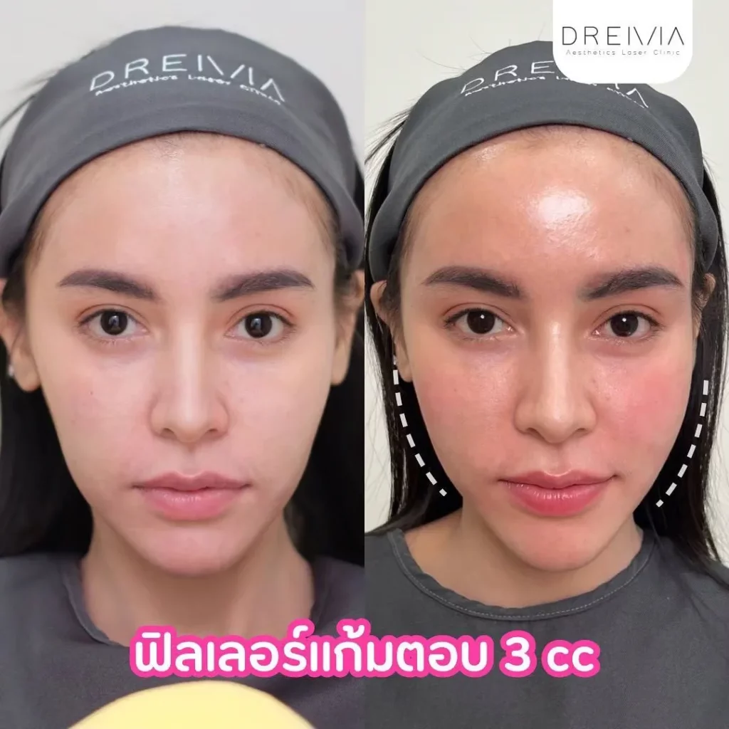 รีวิวการปรับรูปหน้า