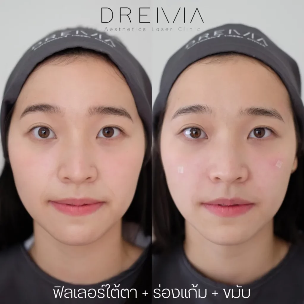 รีวิวการปรับรูปหน้า
