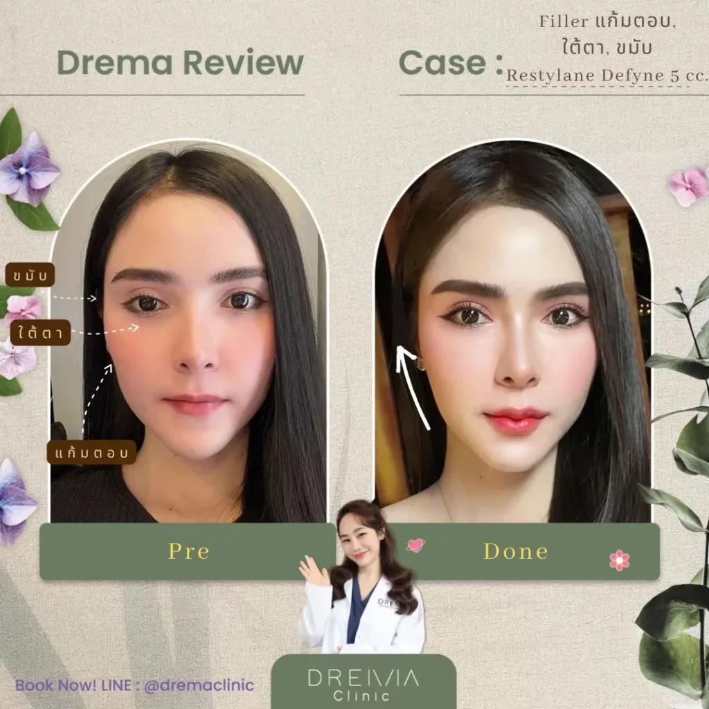 รีวิวการปรับรูปหน้า