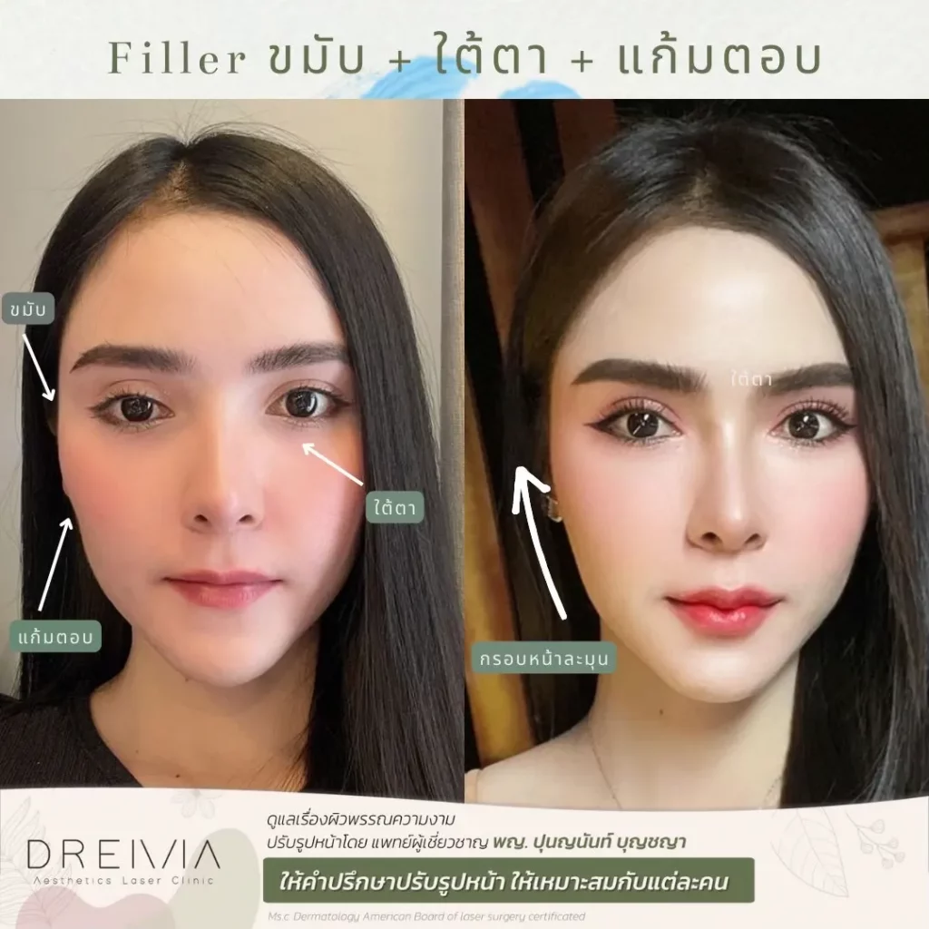 รีวิวการปรับรูปหน้า