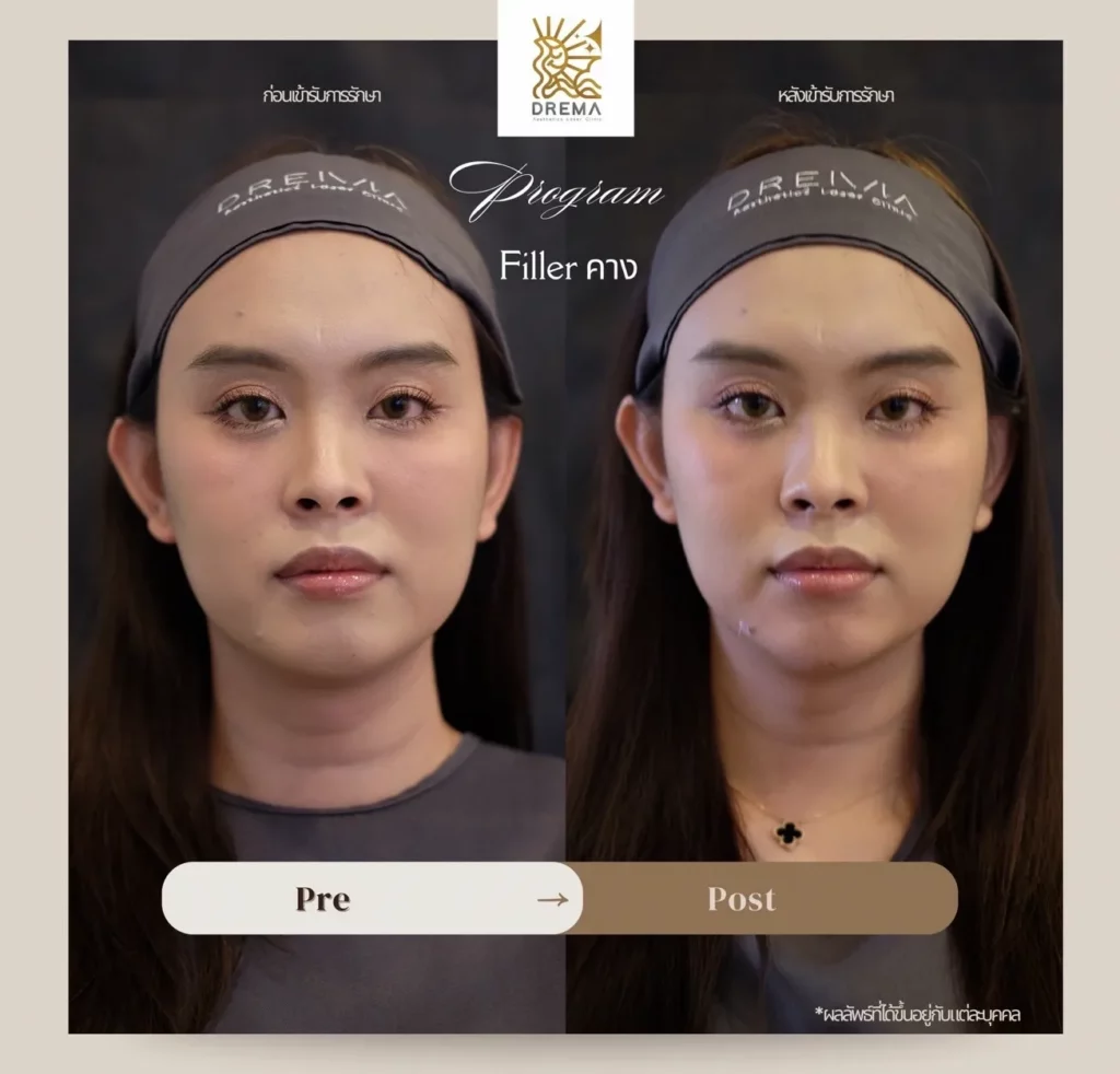 รีวิวฟิลเลอร์คาง