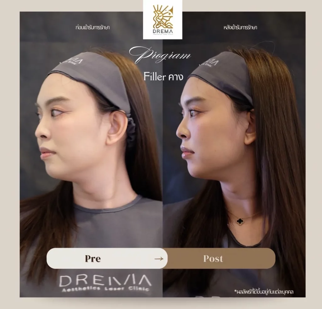 รีวิวฟิลเลอร์คาง