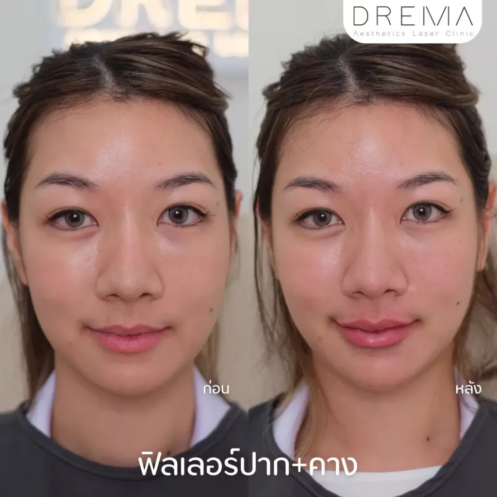 รีวิวฟิลเลอร์คาง