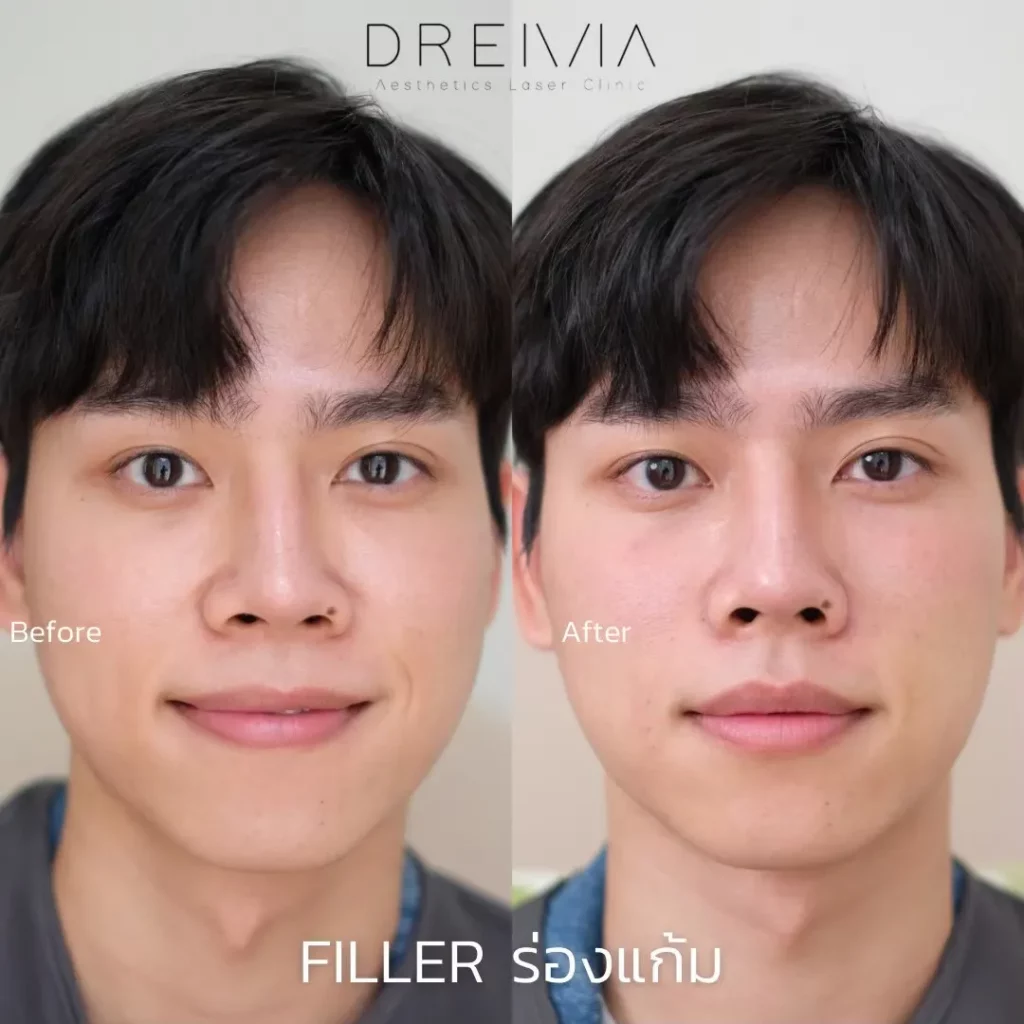 รีวิว Filler แก้มตอบ ร่องแก้ม