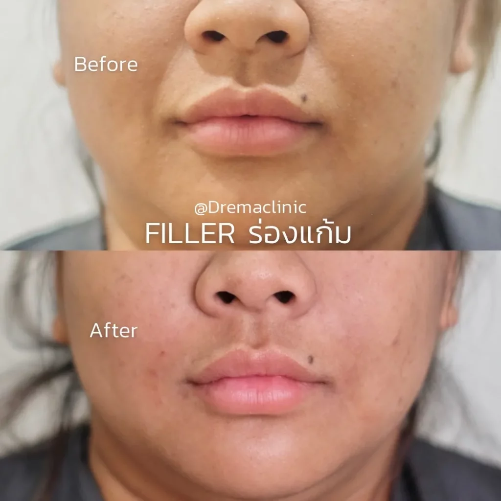 รีวิว Filler แก้มตอบ ร่องแก้ม