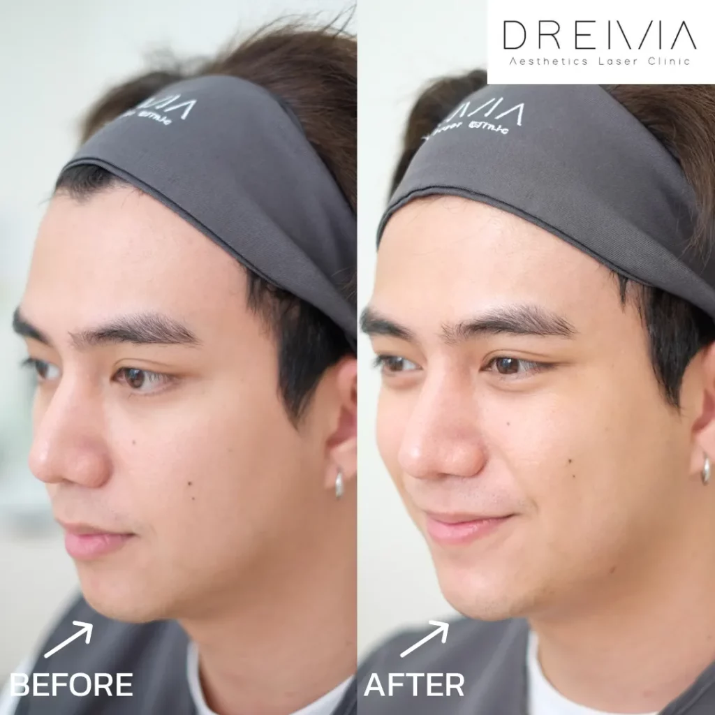 รีวิวฟิลเลอร์คาง