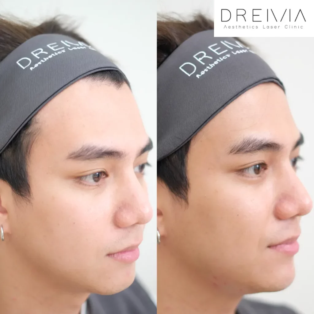 รีวิวฟิลเลอร์คาง