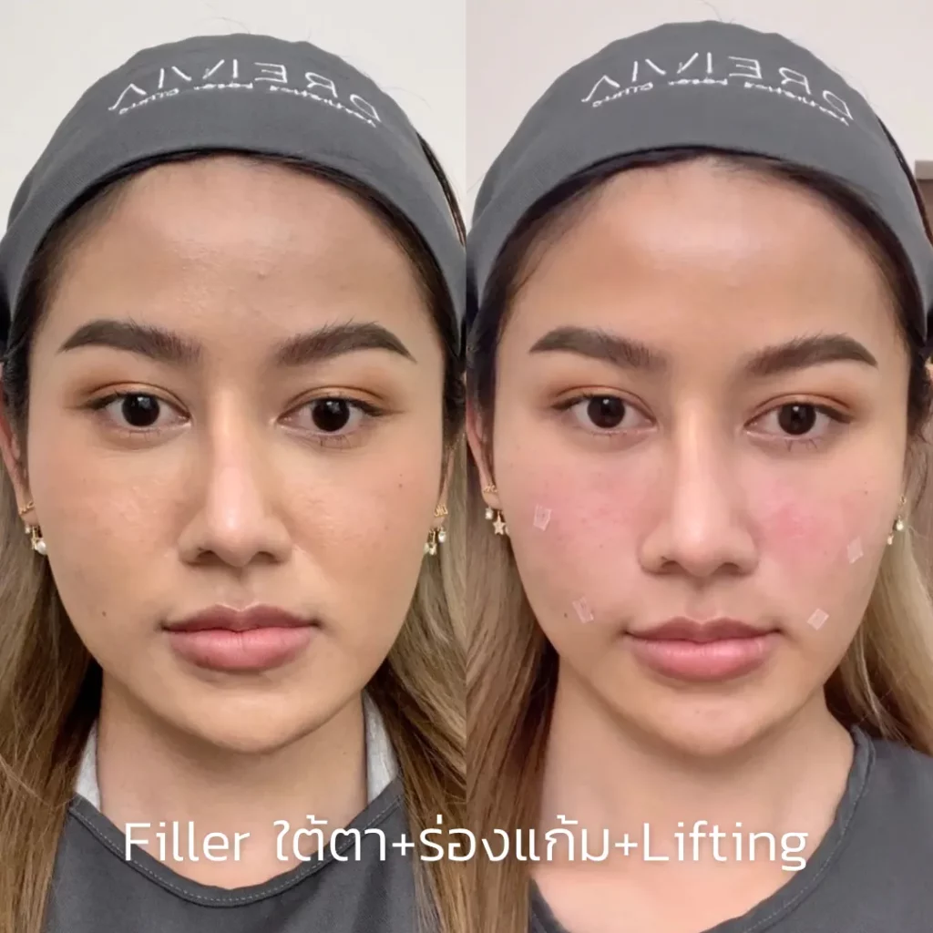 รีวิว Filler แก้มตอบ ร่องแก้ม