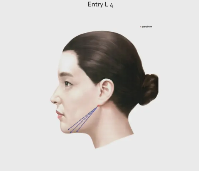 Hybrid thread